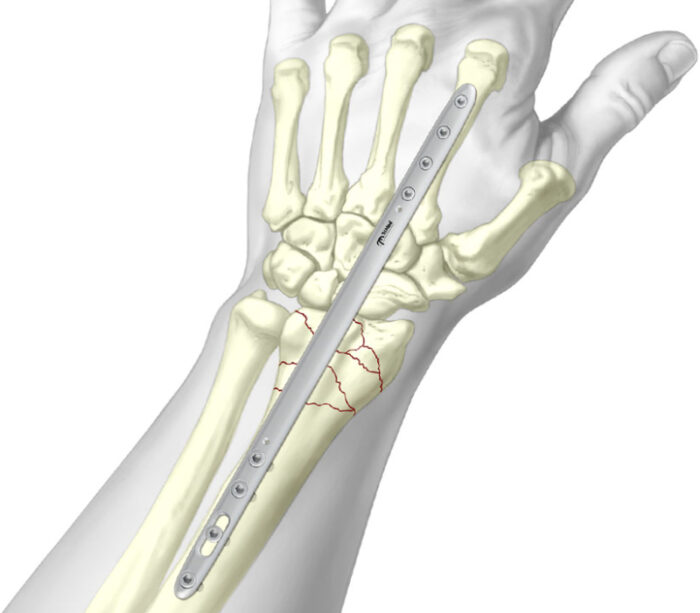 Bridge Plate - Osteotec