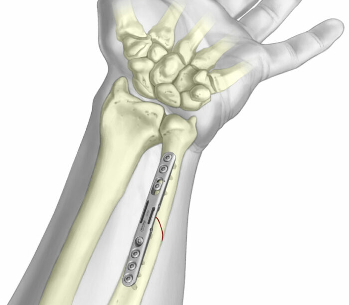 Ulnar Osteotomy Compression Plate - Osteotec