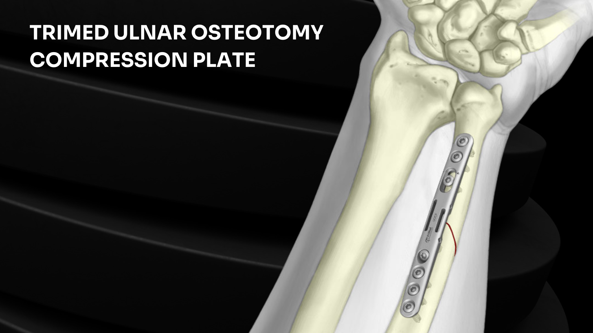 TriMed - Ulnar Osteotomy compression plate